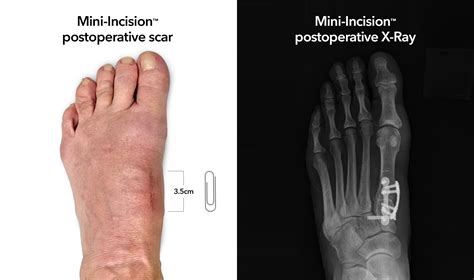 Lapiplasty® Mini-Incision™ System | Treace Medical Concepts, Inc.