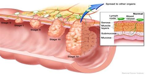 Treatment For Colon Cancer Mayo Clinic Cancerwalls