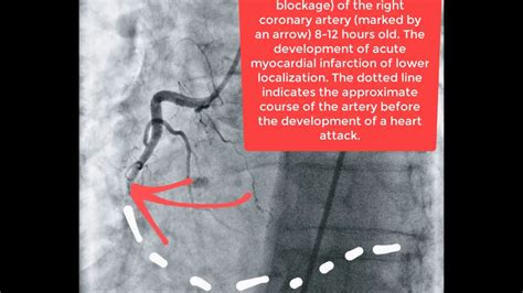 100 percent blockage right coronary artery. The left coronary artery is ...