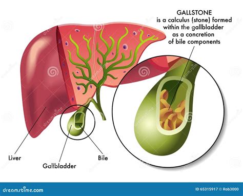 Gallstones Cholelithiasis Cholecystitis Inflammation Of The