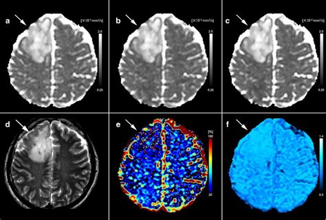 Images From A 49 Year Old Woman With Histologically Proven