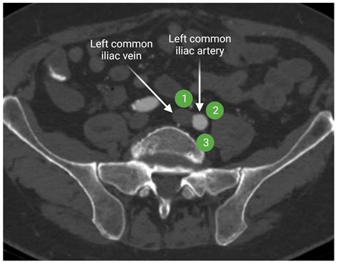 Internal Iliac Lymph Nodes