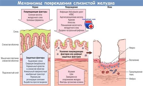 Как правильно лечить гастрит? Травы от гастрита