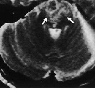 Case 2 A Axial Diffusion Weighted Magnetic Resonance MR Image