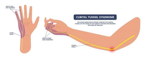 Cubital Tunnel Syndrome Cause Symptoms And Treatment A2z Healthy