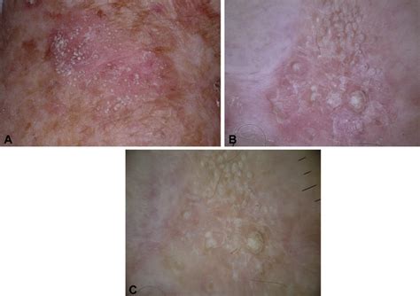 A Red Scaly Plaque With Discrete White Keratotic Papules On The Leg Download Scientific