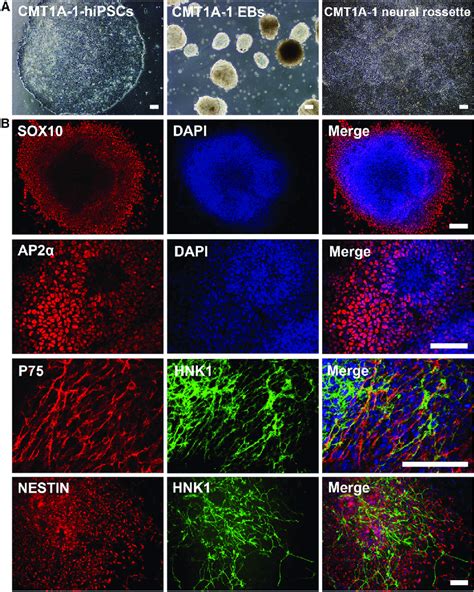 Neural Crest Differentiation Of CMT1A HiPSCs A Human IPSCs Were