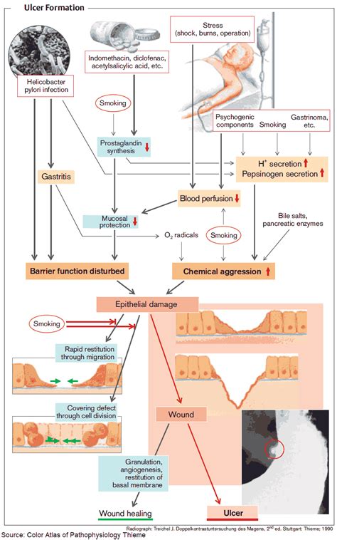 From Heartburn To Ulcers Understanding Peptic Ulcer Disease Manual