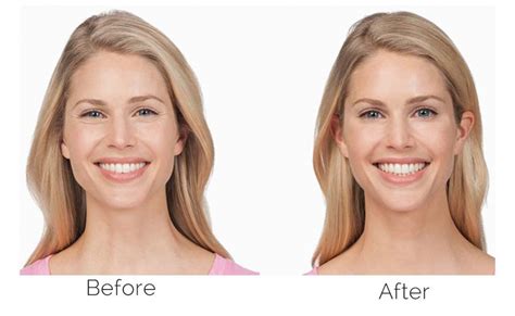 How Does Botox Work Photos Idea