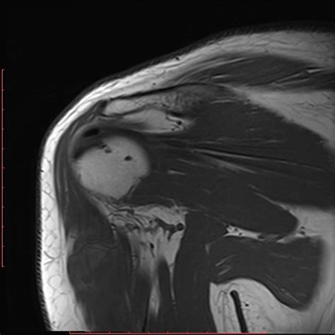 Infraspinatus Calcific Tendinitis Image