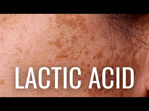 Lactic Acid For Skin Uses And Benefits