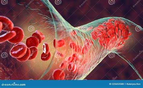 Blood Clot Made Of Red Blood Cells Platelets And Fibrin Protein