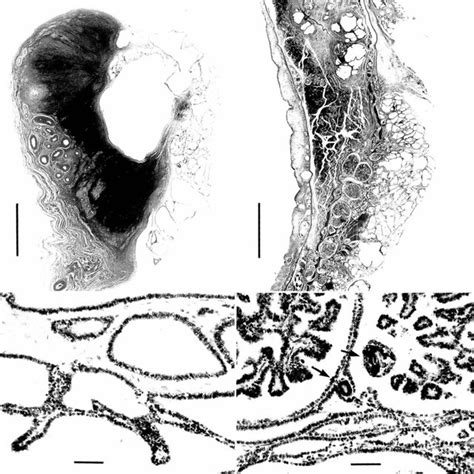 Cystic Tumor On The Ovulation Fossa Of The Left Ovary He Bar 05