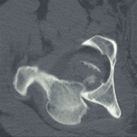 CT Scan Slice Showing A Pipkin Type I Fracture After Femoral Head