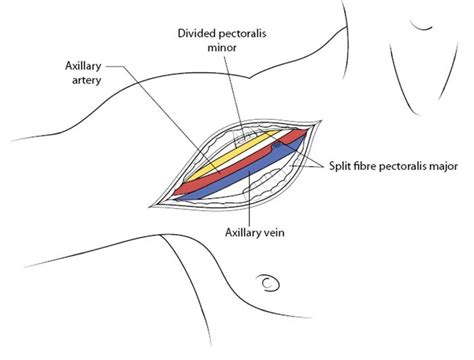 Once The Pectoralis Minor Muscle Has Been Divided This Brings Into Download Scientific Diagram