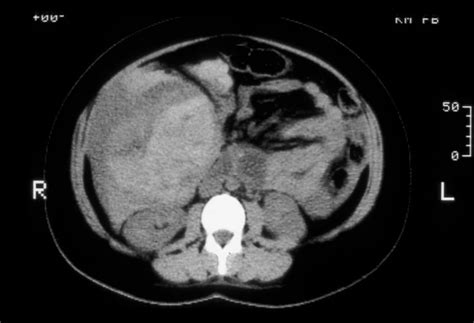 Liver Cancer: Liver Cancer Ct Scan