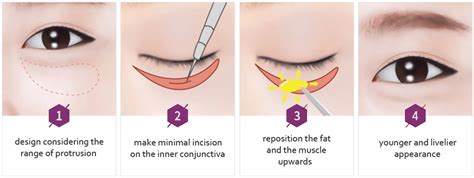 Laser Treatment For Dark Circles Seoul Guide Medical