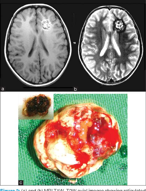 Figure From Giant Cavernous Hemangiomas Of The Brain Semantic Scholar