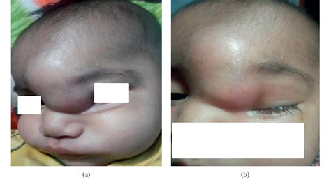 Figure 1 From Potts Puffy TumorPresenting As PyogenicMeningitis In An