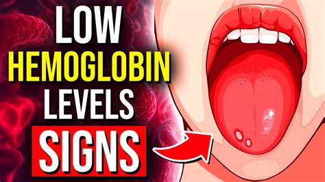 Alarming Signs Of Low Hemoglobin You Cannot Ignore Youtube