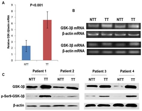 A Relative Expression Level Of Gsk Mrna In Tumor Tissues Tt