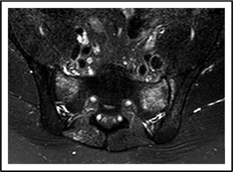 Insufficiency fracture of sacrum. MRI of lumbar spine, axial view (T2).... | Download Scientific ...