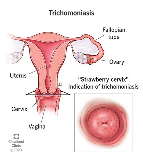 Trichomoniasis Causes Symptoms Testing And Treatment Cleveland Clinic