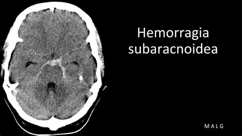 Hemorragia Subaracnoidea Sabidur A M Dica Udocz