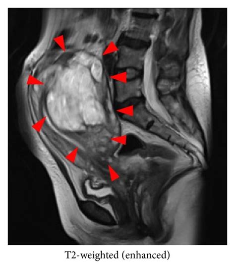 Frontal Pelvic Magnetic Resonance Imaging Demonstrated A Lobular Tumor Download Scientific