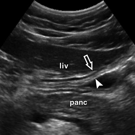 Ultrasound Imaging Of Bowel Pathology Technique And Keys To Diagnosis