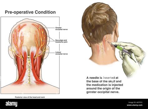 Occipital Nerve Block Injection Stock Photo: 7710002 - Alamy