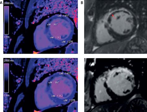 The Role Of Cardiac Magnetic Resonance Non Contrast T1 Mapping In