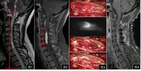 髓內腫瘤患者性別有何差異？治療方法有哪些？哪個階段採取手術？ 每日頭條