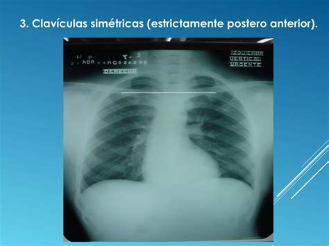 Torax normal en Imagenología PPT