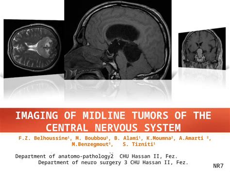 Pptx Imaging Of Midline Tumors Of The Central Nervous System