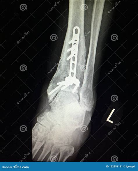 Ankle Left Tibia Distal Fracture Treatment Xray Stock Image | CartoonDealer.com #122251147