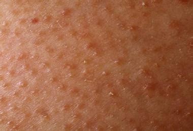 What are these bumps on the back of my arms? | Cindy's Suds