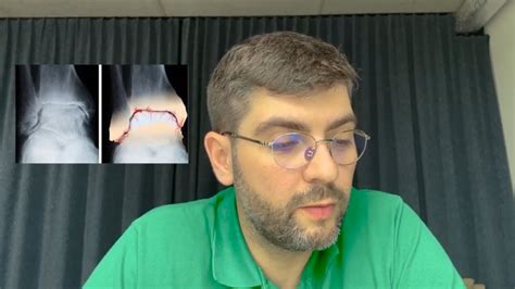 Артроз подтаранного сустава. Что это, как лечить? - YouTube