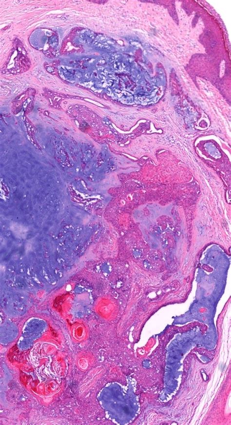 Pathology Of Chondroid Syringoma Illustration Rocks And Crystals