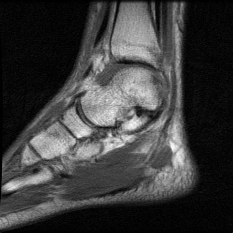 13+ Ankle Ligaments Mri Anatomy