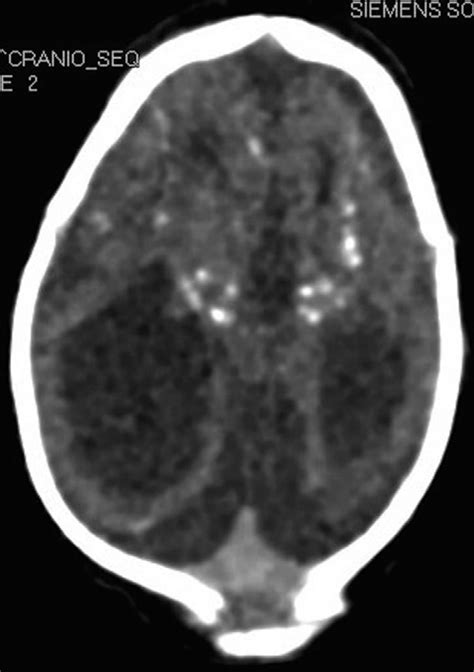 Tomografia Encef Lica Axial Observe A Atrofia Cerebral E Calcifica Es