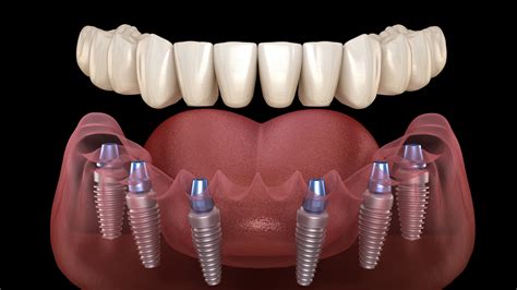 Prothèse dentaire fixe : tout savoir sur ses dispositifs