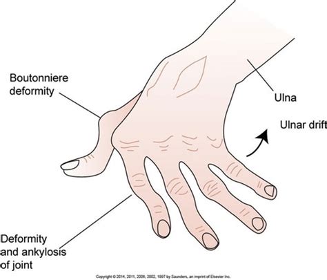 Rheumatology Flashcards Quizlet