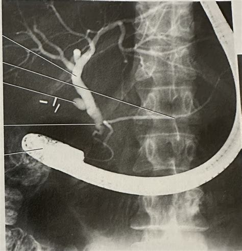 Endoscopic Retrograde Cholangiopancreatography Ercp Diagram Quizlet