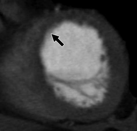 Detection Of Myocardial Infarction Using Delayed Enhancement Dual