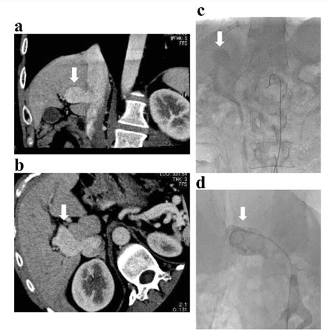 The Findings Of Contrast Enhanced Multidetector Computed Tomography