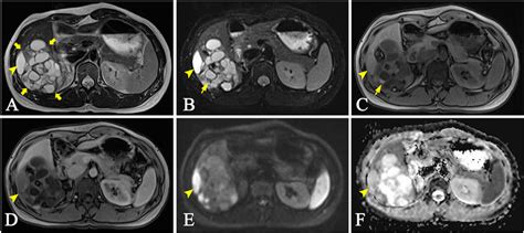 Mri Of A Tumor In The Axial Plane On T2 Tse Sequence A T2 Tse Fs