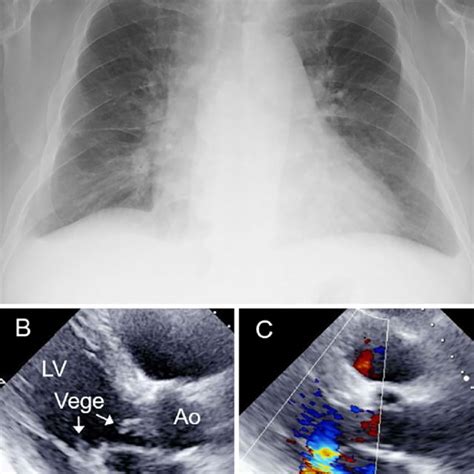 Figure1 Chest X Ray A And A Transthoracic Parasternal Long Axis