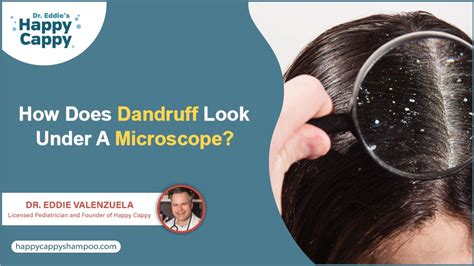 Dandruff Flakes Under Microscope Symptoms Causes And Treatment