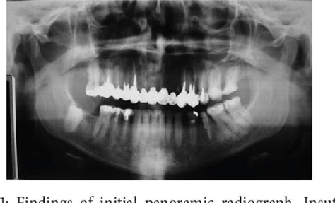 Figure 1 From Dental Extrusion With Orthodontic Miniscrew Anchorage A Case Report Describing A